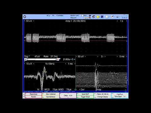 myokymia, fasciculation & denervation - facial nerve