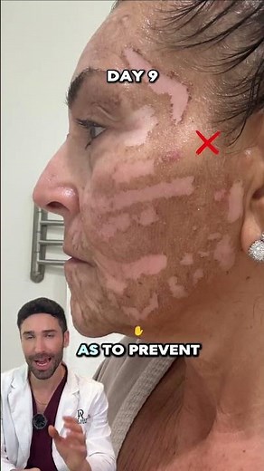 Are you ruining your Erbium result by peeling too soon?#Laser #antiaging #peeling #peeloff #skincare