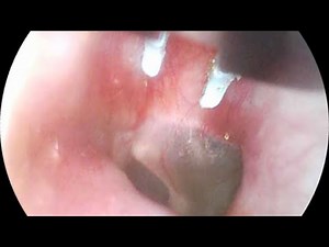 Remote Neural Monitoring Implants 2