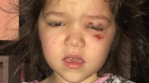 Girl, 4, with severe injuries after washing capsule explodes