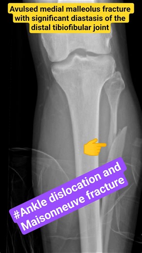 Ankle dislocation and Maisonneuve fracture#shortvideo