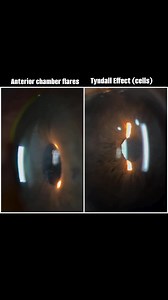 Anterior chamber flares and Tyndall effect (cells). Read more in comments. https://youtube.com/@optometrists2024?si=dLYF9iSAPnFxntsO | OPTOMETRISTS