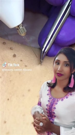 Laser Pen for Fleshy Nevus and Tattoo Removal