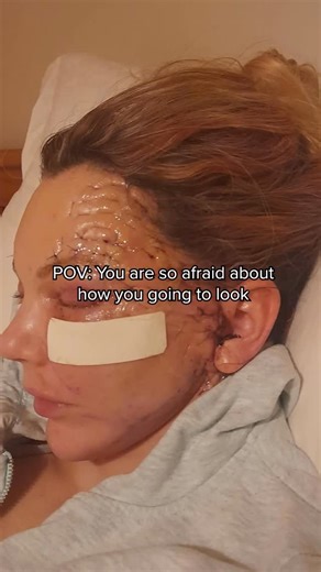 Dr. Julian De Silva on Instagram: "Our lovely long term patient transformation! We know how nerve-wracking the recovery process can be. It’s completely normal to feel apprehensive about the swelling and stitches in those first few days. But as our wonderful patient shares, the results are worth every moment of patience. #DrJulianDeSilva #FaceliftRecovery #BeforeAndAfter #PlasticSurgeryJourney #PatientTestimonial ConfidenceBoost FacialRejuvenation LondonSurgeon SurgeryTransformation"