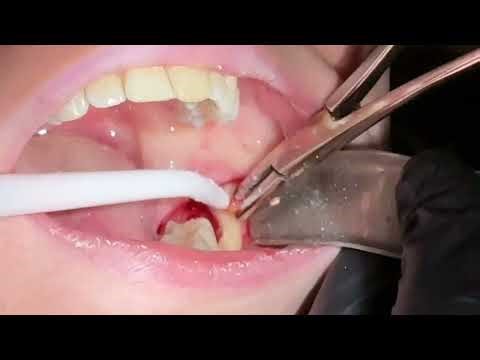 The fastest surgical lower wisdom tooth extraction
