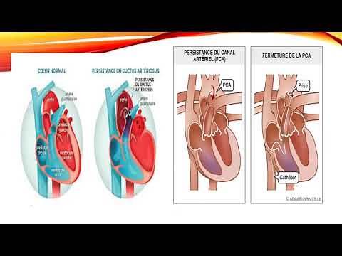 22. Cardiopathies Congénitales (Dr Benlalam) (Parnet) | #Cardio