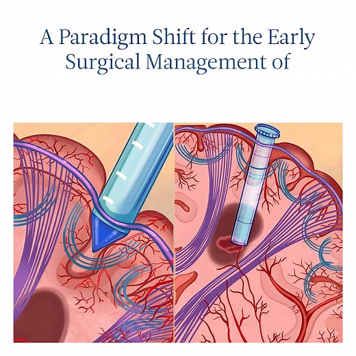 One of the first of its kind, this trial studied the safety and efficacy of early minimally invasive parafascicular surgery (MIPS) evacuation of intracerebral hemorrhage (ICH) using a tubular device as compared to medical management alone. Study results revealed that this was the first trial in history to demonstrate overall function and survival benefit of the surgical removal of ICH. | Montefiore Health System