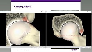 Femoroacetabular Impingement: What Causes It and What Are the Differences Between Pincer and Cam Impingement?