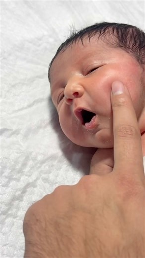 Remove eyeband #baby #neonatologist