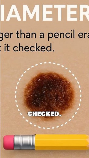 How to Spot a Dangerous Mole Early - ABCDE's Of Mole Detection