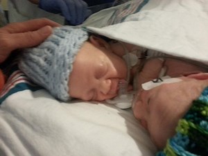 Conjoined Twins Survive 1st Surgery