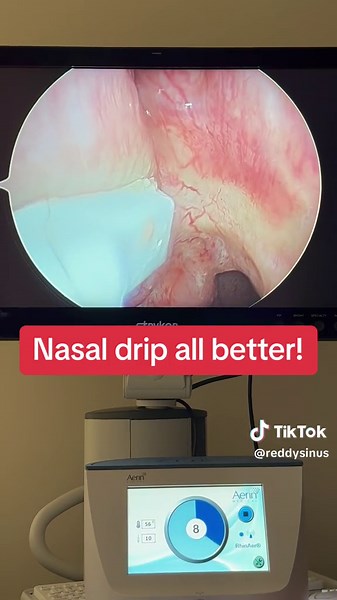 This is the entire RhinAer® procedure! amazing, simple technology for patients with runny nose, nasal drip, or congestion from chronic rhinitis (allergic and/or vasomotor). #aerinmedical #rhinaer #nasaldrip #rhinitis #reddysinus