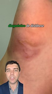 Bolhas começaram a aparecer no pé desta paciente de 16 anos e seu tratamento não apresentava melhora! Esta paciente procurou dois médicos que indicaram a possiblidade de um quadro que não apresentou melhora com o tratamento que sugeriram. Ao avaliar o caso com atenção descobri que a paciente estava enfrentando na verdade outra doença que é muito comum em pessoas que frequentaram um local que ela comentou durante a consulta. Compartilhe este vídeo com amigos e familiares para que todos fiquem ate