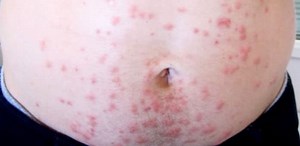 Sea Lice In Cancun 2026 | Best Prevention And Treatment Info