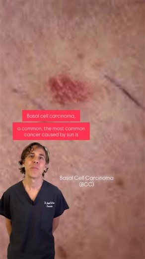 Skin & Beauty Center on Instagram: "Basal Cell Carcinoma (BCC) is the most common form of skin cancer—and the good news is, when caught early, it’s highly treatable. In this video, Dr. Joseph Del Priore explains • what BCC is • what causes it (often long-term sun exposure) • and the treatment options used to remove it safely and effectively If you’ve noticed a spot that doesn’t heal, bleeds easily, or looks different from the rest of your skin, it’s worth getting checked. Early evaluation can ma