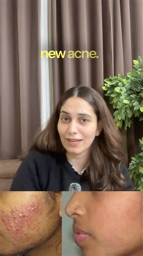 Acne Routine by a Dermatologist | . Read description ⬇️ #acne