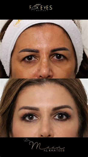 ‎دكتور معن الخطيب‎ | ‎جراحة الجفن والحاجب بتقنية Max Fax الحصرية | Eyelid & Brow Surgery – Max Fax Tchnique 🔹 تصحيح دقيق لترهل الجفون ورفع الحاجب باستخدام تقنية...‎ | Instagram