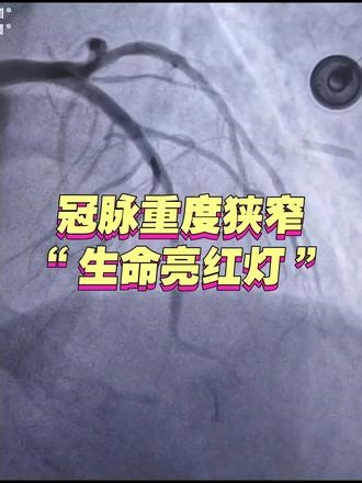 冠脉重度狭窄=生命亮红灯，血管堵死在即，随时诱发心梗夺命，猝死风险陡增，时刻命悬一线，堪称藏在血管里的“致命隐患”。及时住院规范救治，打通生命通道，成功化解致命危机。心脏无小事，胸闷、胸痛别硬扛，早诊早治是关键！#冠心病 #心脏支架#胸痛科普
