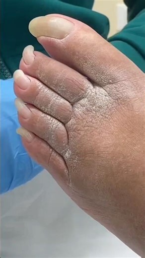 Severely Overgrown Toenails: Clinical Podiatric Treatment & Restoration 👣🩺