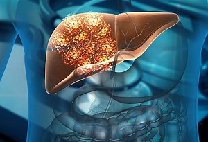 Conozca los factores de riesgo y las primeras señales del cáncer de hígado | Teletica