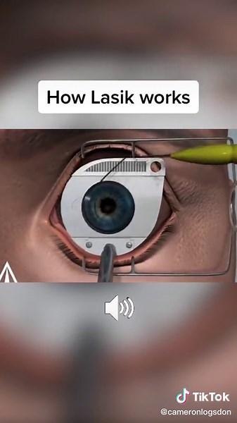 The Unconventional Lasik Eye Surgery Process Explained