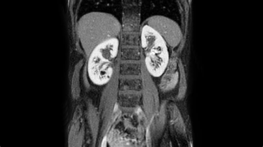 How fever can trigger kidney failure in people with diabetes