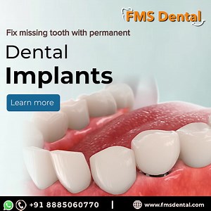 754K views · 299 reactions | Missing teeth shouldn’t stop you from smiling. At FMS Dental, we make world-class dental implants affordable without compromising on quality. Book your consultation today and restore your confidence. | FMS International Dental Center | Facebook