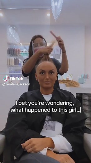 Alopecia Universalis: My Hair Loss Journey Begins