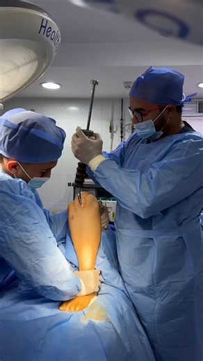 All people should understand one thing carefully by watching this video that it is important to pay attention to keep yourself safe in life, otherwise when there is an accident, some doctors put a rod in the foot like this...