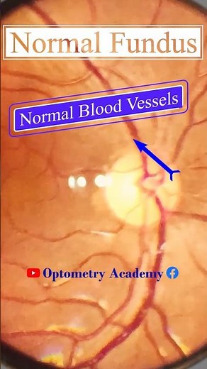 Normal fundus | Normal Retina | Smartphone Fundus Videography | Fundus Photography | Short Video 391