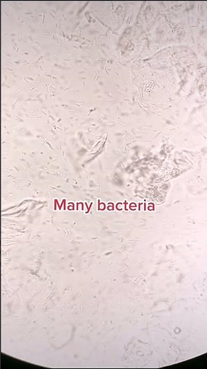Bacteria in urine. Urinary Tract Infection #laboratory #microscope #mls #medtechstudent #cls #urine