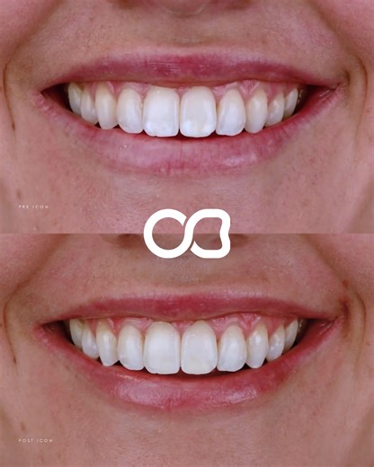 ICON infiltration resin, used to remove All treatments shown are performed by: Dr Bharat Agrawal (DEN0001592232), Registered Dentist, General Registration. BOralH(DentSci), GDipDentistry, MSc Aesthetic Dentistry (Distinction, King’s College London), PGDip Aesthetic & Restorative Dentistry. Icon resin infiltration is a minimally invasive procedure used to treat enamel white spots or early erosion lesions by penetrating the enamel surface with a low-viscosity resin. Possible risks include temporar