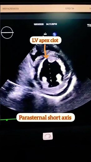 “Rare Echo Finding: Global LV Hypokinesia with Apical Clot Formation"