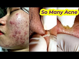 Điều trị mụn bọc, mụn mủ, mụn viêm hiệu quả số 1 TPHCM | Hiền Vân spa | Acne Treatment |693