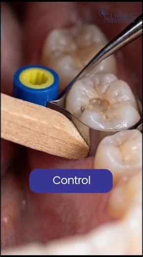 You Don’t See This… But You Feel It | Matrix Control in Dentistry
