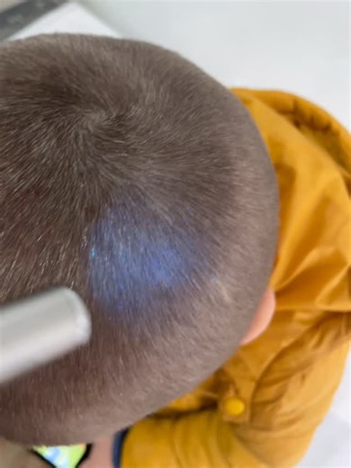 Dr.Aida Omarova 👩🏼‍⚕️ on Instagram: "Ультрафиолетовое свечение (флуоресценция) характерно для некоторых видов грибов. Это явление используется в диагностике грибковых инфекций с помощью ультрафиолетового света (лампы Вуда) Свечение возникает из-за того, что грибы в процессе своей жизнедеятельности производят птеридин — вещество, флюоресцирующее в фиолетовом свете. Свечение может быть ярко-зелёным, сине-зелёным, зелено-голубым, жёлтым, голубовато-белым или синим. Важно: не все виды грибов светя