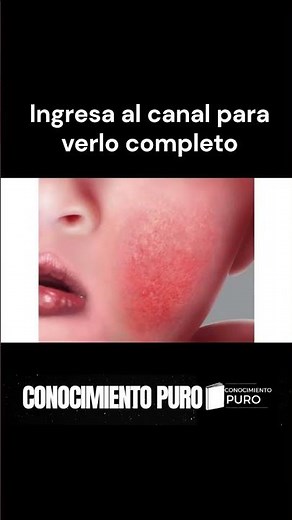 💊 Clobetasol crema: para qué sirve, usos y beneficios en la piel