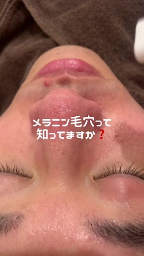 メラニン毛穴ケア：ハイドロフェイシャルの効果