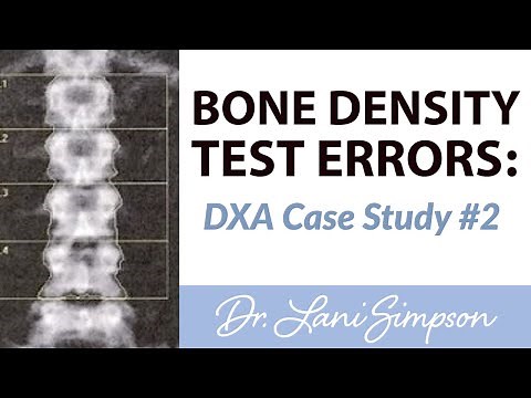 Bone Density Test Errors: DXA Case Study #2