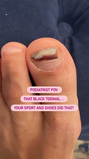 That Black Toenail? Your Sport and Shoes did that! #podiatrist #foot #foothealth