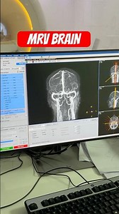 MRV brain. 3T mri machine #viralreels