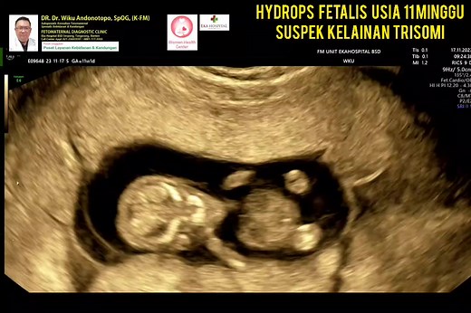 Hydrops fetalis 11 weeks Suspek Trisomi #fetomaternalbatam #fetomaternalmanado #fetomaternalmakassar #usgfetomaternalpontianak #konsultanfetomaternalpontianak #fetomaternalrsiafamilypluit #fetomaternalgrandfamilypik #fetomaternalmalang #usgfetomaternaltangerang #usgfetomaternalbekasi #usgfetomaternalcibubur #usgfetomaternaljakarta #konsultanfetomaternaltangerang #konsultanfetomaternalcibubur #konsultanfetomaternalbekasi #konsultanfetomaternaljakarta #kehamilansehat #fetomaternalpekanbaru #cerita