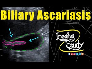 Biliary Ascariasis || Ultrasound || Case 235