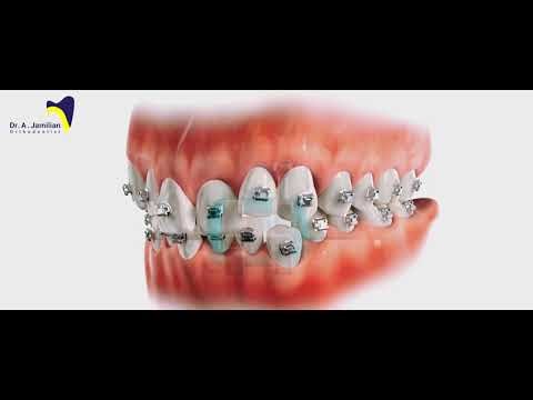 Damon Bracket vs Standard Braces: What’s the Real Difference in Orthodontics #Damon#bracket #braces