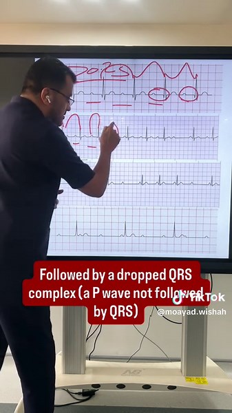 Understanding AV Blocks: Types and Significance