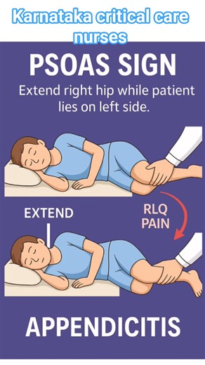 PSOAS SIGN 🛑 #ytshorts #nurse #education #youtubeshorts #viral #appendicitis #psoas