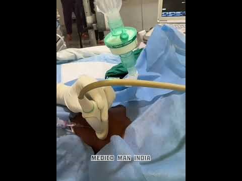 Central line catheter insertion