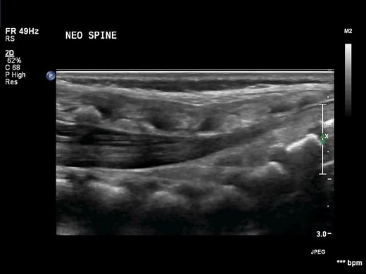 neonatal spine ultrasound normal sagittal