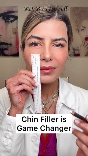 Chin Filler: Facial Balancing for Harmonious Proportions