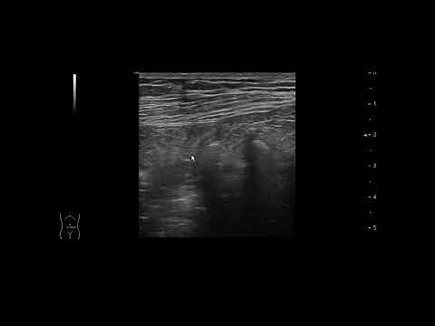 Video 1 - Hernia de Spiegel: diagnóstico ecográfico y revisión de esta patología